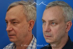 Photo of a patient before and after a procedure. Upper and Lower Blepharoplasty - This delightful 55 year old dislikes the puffy upper and lower eyelids which made him look tired and 'old'. He underwent upper and lower blepharoplasty in Manhattan. The excess skin and fat was removed from the upper eyelid through a perfectly hidden incision. The lower eyelid excess fat was removed from inside the eyelid, so as not to leave any scars.
