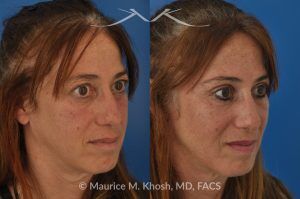 Photo of a patient before and after a procedure. Upper Eyelid Surgery to Remove Excess Skin - This 52 year-old lady was unhappy with droopy and puffy upper eyelids which prevented her from applying eye shadow. She underwent upper eyelid lift, upper blepharoplasty, to get rid of excess skin in the upper eyelid.