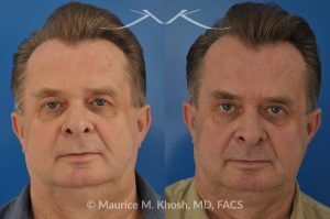 Photo of a patient before and after a procedure. Upper Eyelid Lift - Upper eyelid lift (upper blepharoplasty) to remove excess skin weighing on the eyelashes.