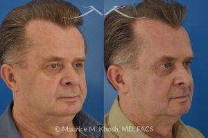 Photo of a patient before and after a procedure. Upper Eyelid Lift - Upper eyelid lift (upper blepharoplasty) to remove excess skin weighing on the eyelashes.
