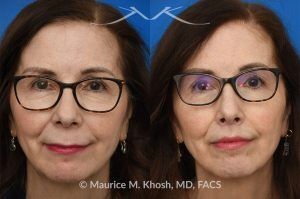 Photo of a patient before and after a procedure. Lip Lift - before and after lip lift procedure showing natural enhancement and improved shape of the lips.