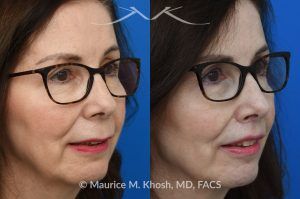 Photo of a patient before and after a procedure. Lip Lift - before and after lip lift procedure showing natural enhancement and improved shape of the lips.