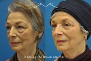 Photo of a patient before and after a procedure. Upper and Lower Blepharoplasty - 66 year old lady with troublesome puffiness of the lower eyelids and saggy upper eyelids. She was successfully treated with upper blepharoplasty and trans-conjunctival (through the inside of eyelid) lower blepharoplasty. Notice the substantial rejuvenated appearance of the entire face resulting from her eyelid lift procedure.