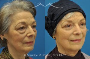 Photo of a patient before and after a procedure. Upper and Lower Blepharoplasty - 66 year old lady with troublesome puffiness of the lower eyelids and saggy upper eyelids. She was successfully treated with upper blepharoplasty and trans-conjunctival (through the inside of eyelid) lower blepharoplasty. Notice the substantial rejuvenated appearance of the entire face resulting from her eyelid lift procedure.