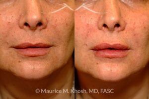 Photo of a patient before and after a procedure. Lip Enhancement with Juvaderm - before and after photo.