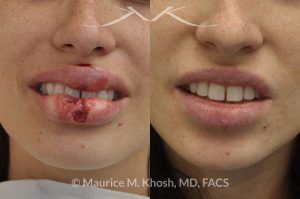 Photo of a patient before and after a procedure. Lip laceration repair after dog bite - before and after results.
