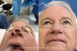 Photo of a patient before and after a procedure. Nasal tip reconstruction after Mohs cancer excision - This lovely patient underwent Mohs excision of basal cell carcinoma of the nasal tip. The defect was repaired with a local flap of nasal skin. The surgery actually helped to improve the nasal appearance by slightly elevating the tip. 