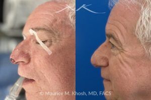 Photo of a patient before and after a procedure. Nasal tip reconstruction after Mohs cancer excision - This lovely patient underwent Mohs excision of basal cell carcinoma of the nasal tip. The defect was repaired with a local flap of nasal skin. The surgery actually helped to improve the nasal appearance by slightly elevating the tip. 