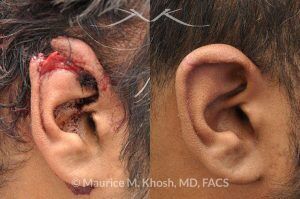 Photo of a patient before and after a procedure. Repair of ear laceration with exposed cartilage - before and after results.