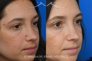 Photo of a patient before and after a procedure. Mole on the left cheek and right side of the nose - before and after removal.