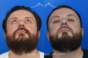 Photo of a patient before and after a procedure. Functional & Cosmetic Septo-Rhinoplasty with Nasal Valve Repair - This gentleman suffered from chronic nasal obstruction, which worsened with exercise, and his right nostril collapsed during deep inhalation. His nasal bridge was deviated to the left, and the tip was bulbous. A septo-rhinoplasty was performed to correct these issues. A deviated septum was repaired, and a right-sided spreader graft was used to straighten the nasal bridge. Nostril collapse was corrected with a combination of cephalic trimming of the alar cartilages and alar strut grafts, which also improved the cosmetic appearance of the nasal tip.