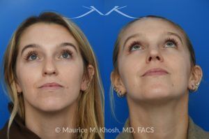 Photo of a patient before and after a procedure. Hump Reduction and Tip Refinement - Our patient came to us seeking a rhinoplasty to refine the overall appearance of her nose. Her goals included smoothing the nasal hump, lifting and narrowing the nasal tip, and preventing the tip from drooping when she smiled. Using an open rhinoplasty approach, we performed dorsal reduction, spreader flaps, cephalic trim, and placement of a septal extension graft to achieve a balanced and stable result.Her 7-month postoperative photos show a beautifully refined yet completely natural outcome that harmonizes with her facial features. She is thrilled with her new nose and the confidence it has brought her.