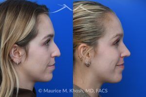 Photo of a patient before and after a procedure. Hump Reduction and Tip Refinement - Our patient came to us seeking a rhinoplasty to refine the overall appearance of her nose. Her goals included smoothing the nasal hump, lifting and narrowing the nasal tip, and preventing the tip from drooping when she smiled. Using an open rhinoplasty approach, we performed dorsal reduction, spreader flaps, cephalic trim, and placement of a septal extension graft to achieve a balanced and stable result.Her 7-month postoperative photos show a beautifully refined yet completely natural outcome that harmonizes with her facial features. She is thrilled with her new nose and the confidence it has brought her.