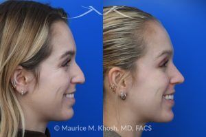 Photo of a patient before and after a procedure. Hump Reduction and Tip Refinement - Our patient came to us seeking a rhinoplasty to refine the overall appearance of her nose. Her goals included smoothing the nasal hump, lifting and narrowing the nasal tip, and preventing the tip from drooping when she smiled. Using an open rhinoplasty approach, we performed dorsal reduction, spreader flaps, cephalic trim, and placement of a septal extension graft to achieve a balanced and stable result.Her 7-month postoperative photos show a beautifully refined yet completely natural outcome that harmonizes with her facial features. She is thrilled with her new nose and the confidence it has brought her.