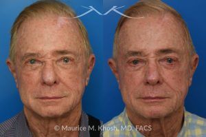 Photo of a patient before and after a procedure. Comprehensive Rhinoplasty and Brow Symmetry Restoration After Forehead Flap Reconstruction - This gentleman sought consultation for enhancement of the nose and increased symmetry in the position of his eyebrows. He had previously undergone excision of a large skin cancer from the right lower nose which was reconstructed with a left forehead flap (skin from the forehead was moved to the nose to cover the surgical defect). The flap resulted in a puffy appearing lower nose and exacerbated the droopy and deviated appearing nasal tip. Additionally, skin removal from the forehead elevated the position of the left eyebrow and resulted in a wide scar in the left upper forehead. 
During rhinoplasty surgery, the contour of the bridge and the tip of was improved and the puffy appearing flap was thinned. The brow lift surgery helped to elevate the right brow to match the position of the left eyebrow. The wide scar in the left forehead was eliminated. 