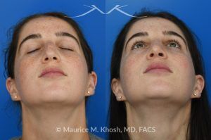 Photo of a patient before and after a procedure. Open Rhinoplasty for C-Shaped Deviation and Dorsal Hump Reduction - Open rhinoplasty was performed to correct a C-shaped dorsal deviation, reduce a dorsal hump on profile view, and elevate a ptotic nasal tip. A septoplasty was carried out concurrently to address septal deviation and to harvest cartilage for grafting. Following dorsal reduction, spreader grafts were placed—two layered on the left side—to restore dorsal aesthetic lines and improve symmetry. Bilateral lateral osteotomies and a left-sided intermediate osteotomy were performed to realign the nasal bones. Tip elevation and support were maintained with septo-columellar sutures.