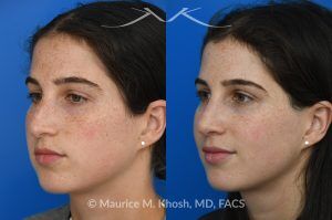 Photo of a patient before and after a procedure. Open Rhinoplasty for C-Shaped Deviation and Dorsal Hump Reduction - Open rhinoplasty was performed to correct a C-shaped dorsal deviation, reduce a dorsal hump on profile view, and elevate a ptotic nasal tip. A septoplasty was carried out concurrently to address septal deviation and to harvest cartilage for grafting. Following dorsal reduction, spreader grafts were placed—two layered on the left side—to restore dorsal aesthetic lines and improve symmetry. Bilateral lateral osteotomies and a left-sided intermediate osteotomy were performed to realign the nasal bones. Tip elevation and support were maintained with septo-columellar sutures.
