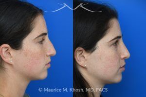 Photo of a patient before and after a procedure. Open Rhinoplasty for C-Shaped Deviation and Dorsal Hump Reduction - Open rhinoplasty was performed to correct a C-shaped dorsal deviation, reduce a dorsal hump on profile view, and elevate a ptotic nasal tip. A septoplasty was carried out concurrently to address septal deviation and to harvest cartilage for grafting. Following dorsal reduction, spreader grafts were placed—two layered on the left side—to restore dorsal aesthetic lines and improve symmetry. Bilateral lateral osteotomies and a left-sided intermediate osteotomy were performed to realign the nasal bones. Tip elevation and support were maintained with septo-columellar sutures.