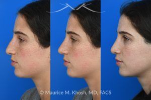 Photo of a patient before and after a procedure. Open Rhinoplasty for C-Shaped Deviation and Dorsal Hump Reduction - Open rhinoplasty was performed to correct a C-shaped dorsal deviation, reduce a dorsal hump on profile view, and elevate a ptotic nasal tip. A septoplasty was carried out concurrently to address septal deviation and to harvest cartilage for grafting. Following dorsal reduction, spreader grafts were placed—two layered on the left side—to restore dorsal aesthetic lines and improve symmetry. Bilateral lateral osteotomies and a left-sided intermediate osteotomy were performed to realign the nasal bones. Tip elevation and support were maintained with septo-columellar sutures.