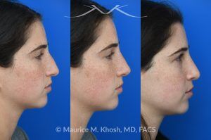 Photo of a patient before and after a procedure. Open Rhinoplasty for C-Shaped Deviation and Dorsal Hump Reduction - Open rhinoplasty was performed to correct a C-shaped dorsal deviation, reduce a dorsal hump on profile view, and elevate a ptotic nasal tip. A septoplasty was carried out concurrently to address septal deviation and to harvest cartilage for grafting. Following dorsal reduction, spreader grafts were placed—two layered on the left side—to restore dorsal aesthetic lines and improve symmetry. Bilateral lateral osteotomies and a left-sided intermediate osteotomy were performed to realign the nasal bones. Tip elevation and support were maintained with septo-columellar sutures.