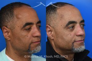 Photo of a patient before and after a procedure. Precision Lipoma Excision on the Right Temple - A medium sized lipoma on the right temple was excised, leaving no recognizable scar. Lipoma excision in the temple region requires exacting precision to avoid injuring the facial nerve branch that elevates the brow. 