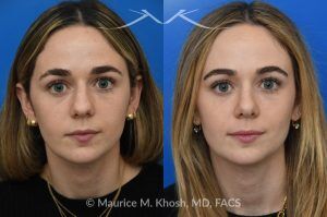 Photo of a patient before and after a procedure. Rhinoplasty to Smooth a Dorsal Hump and Narrow and Refine the Tip - This young patient sought to refine her nose while preserving her natural features. An open approach rhinoplasty was performed, including a conservative dorsal shave, cephalic trimming of the alar cartilages, and placement of alar strut grafts to support and straighten the alae. We used a septal extension graft to precisely control nasal tip rotation and projection, and performed osteotomies to narrow the bony bridge.