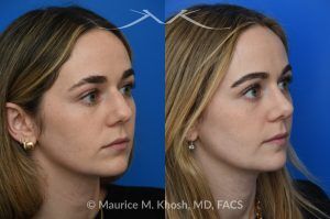 Photo of a patient before and after a procedure. Rhinoplasty to Smooth a Dorsal Hump and Narrow and Refine the Tip - This young patient sought to refine her nose while preserving her natural features. An open approach rhinoplasty was performed, including a conservative dorsal shave, cephalic trimming of the alar cartilages, and placement of alar strut grafts to support and straighten the alae. We used a septal extension graft to precisely control nasal tip rotation and projection, and performed osteotomies to narrow the bony bridge.