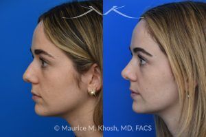Photo of a patient before and after a procedure. Rhinoplasty to Smooth a Dorsal Hump and Narrow and Refine the Tip - This young patient sought to refine her nose while preserving her natural features. An open approach rhinoplasty was performed, including a conservative dorsal shave, cephalic trimming of the alar cartilages, and placement of alar strut grafts to support and straighten the alae. We used a septal extension graft to precisely control nasal tip rotation and projection, and performed osteotomies to narrow the bony bridge.