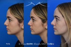 Photo of a patient before and after a procedure. Rhinoplasty to Smooth a Dorsal Hump and Narrow and Refine the Tip - This young patient sought to refine her nose while preserving her natural features. An open approach rhinoplasty was performed, including a conservative dorsal shave, cephalic trimming of the alar cartilages, and placement of alar strut grafts to support and straighten the alae. We used a septal extension graft to precisely control nasal tip rotation and projection, and performed osteotomies to narrow the bony bridge.