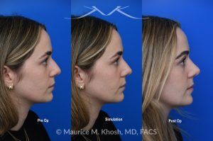 Photo of a patient before and after a procedure. Rhinoplasty to Smooth a Dorsal Hump and Narrow and Refine the Tip - This young patient sought to refine her nose while preserving her natural features. An open approach rhinoplasty was performed, including a conservative dorsal shave, cephalic trimming of the alar cartilages, and placement of alar strut grafts to support and straighten the alae. We used a septal extension graft to precisely control nasal tip rotation and projection, and performed osteotomies to narrow the bony bridge.