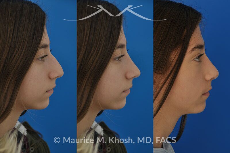 Rhinoplasty for a refined nose with smoth bridge tip elevation and tip narrowing