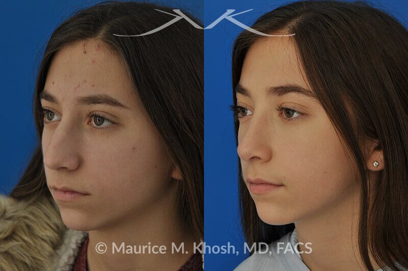 Rhinoplasty for a refined nose with smoth bridge tip elevation and tip narrowing