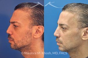 Photo of a patient before and after a procedure. Repair of nose fracture - before and after results.
