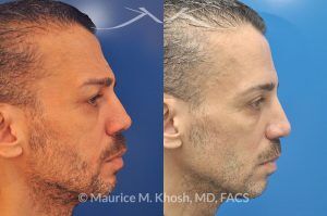 Photo of a patient before and after a procedure. Repair of nose fracture - before and after results.