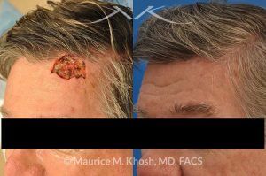 Photo of a patient before and after a procedure. Mohs' repair of forehead scalp - before and after results.