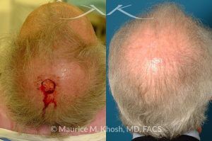 Photo of a patient before and after a procedure. Moh's defect, scalp repair - before and after photos.