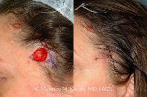 Photo of a patient before and after a procedure. Mohs defect scalp and temple - before and after results.