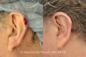 Photo of a patient before and after a procedure. Moh's defect - before and after results.