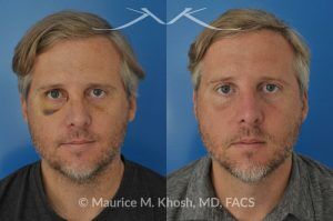 Photo of a patient before and after a procedure. Repair of broken nose - before and after results.