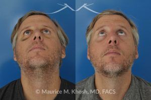 Photo of a patient before and after a procedure. Repair of broken nose - before and after results.