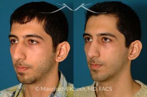 Photo of a patient before and after a procedure. Rhinoplasty and chin implant - before and after photo.