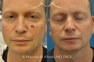 Photo of a patient before and after a procedure. Cheek reconstruction after Mohs skin cancer removal - before and after photos.