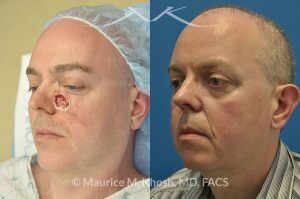 Photo of a patient before and after a procedure. Cheek reconstruction after Mohs skin cancer removal - before and after photos.