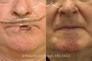 Photo of a patient before and after a procedure. Lip recnostruction for Mohs cancer defect - before and after photos.