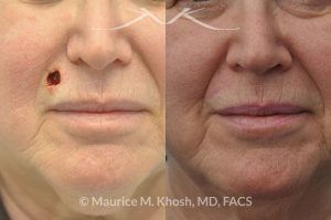 Photo of a patient before and after a procedure. Upper lip Mohs cancer defect repair - before and after photos.