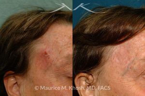 Photo of a patient before and after a procedure. Temple skin reconstruction with skin graft - before and after results.