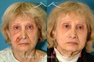 Photo of a patient before and after a procedure. Lip reconstruction for Mohs skin cancer defect - before and after results.