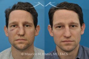 Photo of a patient before and after a procedure. Nose Fracture - before and after results.