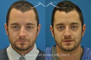 Photo of a patient before and after a procedure. Nose Fracture - before and after results.