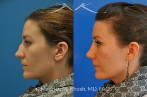 Photo of a patient before and after a procedure. Nose Fracture - before and after results.